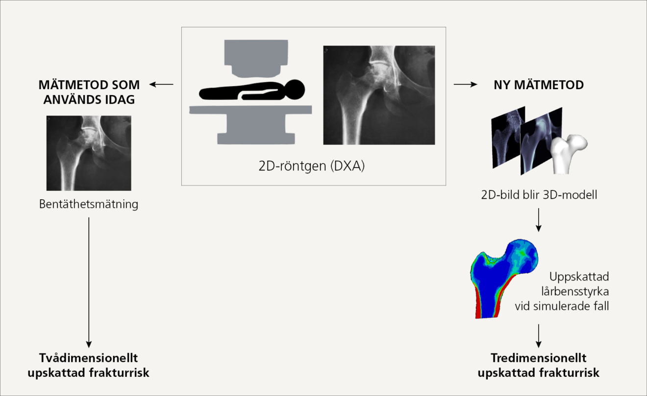 Ny metod ska bättre upptäcka benskörhet